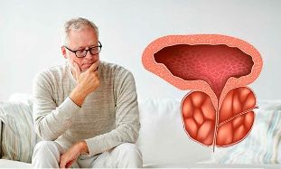 chronický zápal prostaty štádium