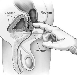 liečba prostaty, v dome masáž