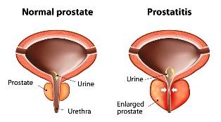 akútny zápal prostaty liečba