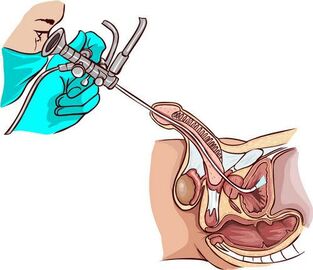 Postup ureteroskopie